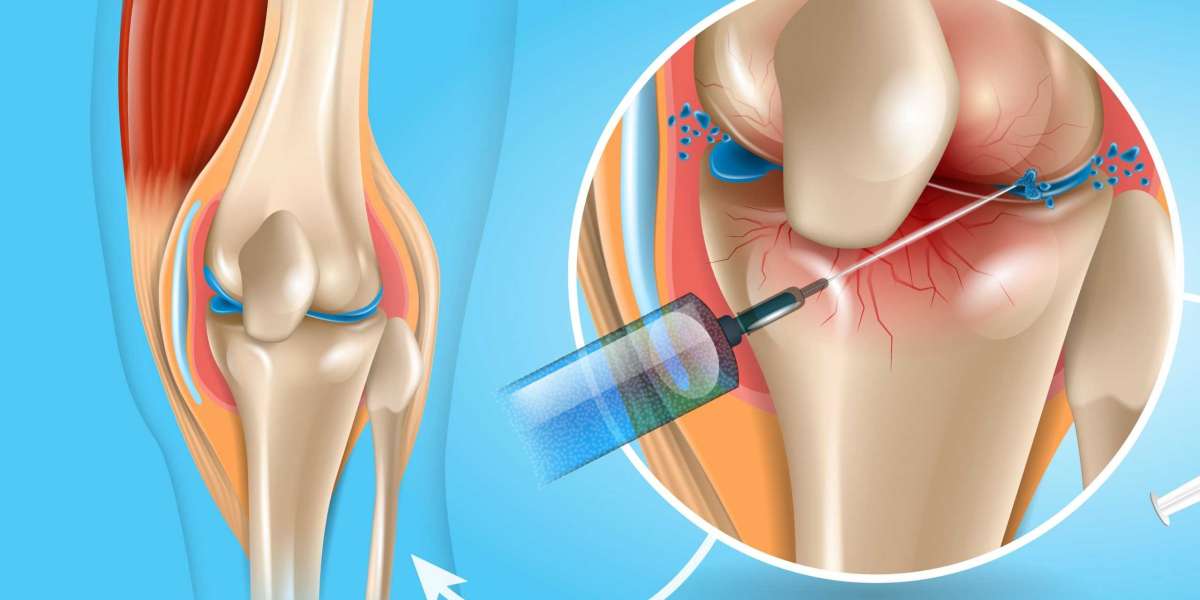 Osteoarthritis Therapeutics Market Size, Share, Trends, Report 2032